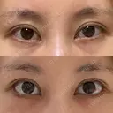 目尻切開 / タレ目形成・グラマラスライン（切開） eクリニック 金沢本院 DAY 28 サムネイル用