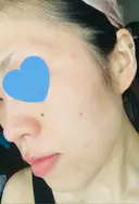 その他（肌） / ピーリング（ニキビ・毛穴） / イオン導入 / フォトシルクプラス / 光治療（フォトフェイシャルなど） / ウーバーピール / ニキビ治療 ハニークリニック AFTER サムネイル用