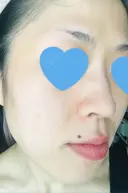 その他（肌） / ピーリング（ニキビ・毛穴） / イオン導入 / フォトシルクプラス / 光治療（フォトフェイシャルなど） / ウーバーピール / ニキビ治療 ハニークリニック DAY 13 サムネイル用