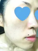 その他（肌） / ピーリング（ニキビ・毛穴） / イオン導入 / フォトシルクプラス / 光治療（フォトフェイシャルなど） / ウーバーピール / ニキビ治療 ハニークリニック DAY 10 サムネイル用