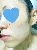 その他（肌） / ピーリング（ニキビ・毛穴） / イオン導入 / フォトシルクプラス / 光治療（フォトフェイシャルなど） / ウーバーピール / ニキビ治療 ハニークリニック DAY 10 サムネイル用