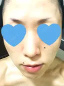 その他（肌） / ピーリング（ニキビ・毛穴） / イオン導入 / フォトシルクプラス / 光治療（フォトフェイシャルなど） / ウーバーピール / ニキビ治療 ハニークリニック DAY 10 サムネイル用