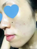 その他（肌） / ピーリング（ニキビ・毛穴） / イオン導入 / フォトシルクプラス / 光治療（フォトフェイシャルなど） / ウーバーピール / ニキビ治療 ハニークリニック DAY 9 サムネイル用