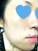 その他（肌） / ピーリング（ニキビ・毛穴） / イオン導入 / フォトシルクプラス / 光治療（フォトフェイシャルなど） / ウーバーピール / ニキビ治療 ハニークリニック DAY 9 サムネイル用