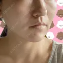 その他（目元） / 糸リフト / ボトックス（エラ・小顔） / 脂肪溶解注射（顔） / ボトックス（目尻） アリエル美容クリニック 大宮院 DAY 3 サムネイル用