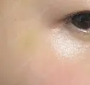 美容点滴・美容注射（美肌） / その他（肌） チョンダムジュエンクリニック DAY 10 サムネイル用