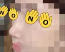 隆鼻術 / 鼻尖形成（切開） / 眉間プロテーゼ サラ美容外科 DAY 23 サムネイル用