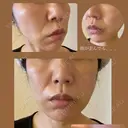 糸リフト / 脂肪吸引（顔） / ジョールファット除去 湘南美容クリニック 秋葉原院 AFTER サムネイル用