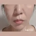 糸リフト / 脂肪吸引（顔） / ジョールファット除去 湘南美容クリニック 秋葉原院 DAY 5 サムネイル用