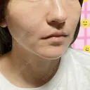 その他（目元） / 糸リフト / ボトックス（エラ・小顔） / 脂肪溶解注射（顔） / ボトックス（目尻） アリエル美容クリニック 大宮院 DAY 4 サムネイル用