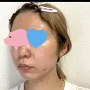 ピーリング（ニキビ・毛穴） / イオン導入 渋谷美容外科クリニック 新宿院 AFTER サムネイル用