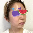 ピーリング（ニキビ・毛穴） / イオン導入 渋谷美容外科クリニック 新宿院 DAY 15 サムネイル用