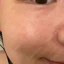 毛穴洗浄（ハイドラフェイシャルなど） 東京素肌クリニック 銀座本院 DAY 13 サムネイル用