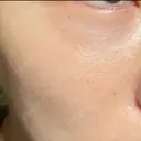 毛穴洗浄（ハイドラフェイシャルなど） 東京素肌クリニック 銀座本院 DAY 11 サムネイル用