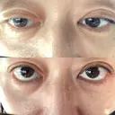 二重埋没 EMMO FACE CLINIC 大宮院 DAY 1 サムネイル用