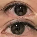 ボトックス（タレ目） STARS CLINIC AFTER サムネイル用