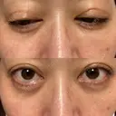 二重埋没 EMMO FACE CLINIC 大宮院 DAY 2 サムネイル用