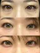 クマ治療 / 下まぶたの脂肪取り / 脂肪注入（肌） X CLINIC 大阪院 AFTER サムネイル用
