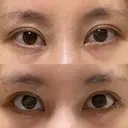 目尻切開 / タレ目形成・グラマラスライン（切開） eクリニック 金沢本院 DAY 29 サムネイル用