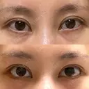目尻切開 / タレ目形成・グラマラスライン（切開） eクリニック 金沢本院 DAY 30 サムネイル用