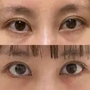目尻切開 / タレ目形成・グラマラスライン（切開） eクリニック 金沢本院 AFTER サムネイル用