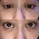 二重埋没 EMMO FACE CLINIC 大宮院 DAY 3 サムネイル用