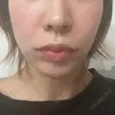 肌ヒアルロン酸注入（たるみ・シワ改善） STARS CLINIC DAY 1 サムネイル用