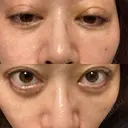 二重埋没 EMMO FACE CLINIC 大宮院 DAY 4 サムネイル用