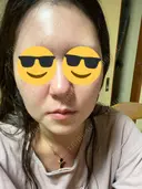 ボトックス（エラ・小顔） / ボトックス（眉間） TCB東京中央美容外科 神戸院 AFTER サムネイル用