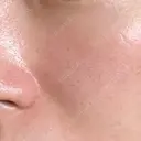 ヴェルヴェットスキン STARS CLINIC AFTER サムネイル用