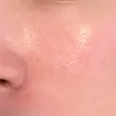 ヴェルヴェットスキン STARS CLINIC DAY 1 サムネイル用