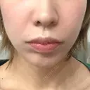 肌ヒアルロン酸注入（たるみ・シワ改善） STARS CLINIC DAY 2 サムネイル用