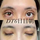 二重切開 / 上まぶたの脂肪取り オーキッド美容クリニック東京御徒町 DAY 6 サムネイル用