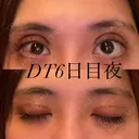 二重切開 / 上まぶたの脂肪取り オーキッド美容クリニック東京御徒町 DAY 6 サムネイル用
