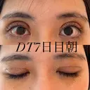 二重切開 / 上まぶたの脂肪取り オーキッド美容クリニック東京御徒町 DAY 7 サムネイル用