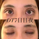 二重切開 / 上まぶたの脂肪取り オーキッド美容クリニック東京御徒町 DAY 7 サムネイル用