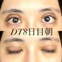 二重切開 / 上まぶたの脂肪取り オーキッド美容クリニック東京御徒町 DAY 8 サムネイル用