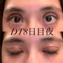 二重切開 / 上まぶたの脂肪取り オーキッド美容クリニック東京御徒町 DAY 8 サムネイル用