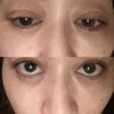 二重埋没 EMMO FACE CLINIC 大宮院 DAY 10 サムネイル用