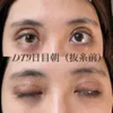 二重切開 / 上まぶたの脂肪取り オーキッド美容クリニック東京御徒町 DAY 9 サムネイル用