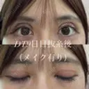 二重切開 / 上まぶたの脂肪取り オーキッド美容クリニック東京御徒町 DAY 9 サムネイル用