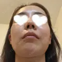 ハイフ（顔） 湘南美容クリニック 岡山院 DAY 9 サムネイル用