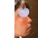 鼻尖形成（切開） Olino美容外科・美容皮膚科 DAY 47 サムネイル用