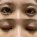 二重切開 / 目頭切開 / クマ治療 / 上まぶたの脂肪取り / 下まぶたの脂肪取り / タレ目形成・グラマラスライン（切開） BRIGHTS beauty clinic DAY 22 サムネイル用