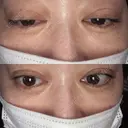 二重埋没 EMMO FACE CLINIC 大宮院 DAY 13 サムネイル用