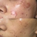 ピコスポット Olino美容外科・美容皮膚科 DAY 5 サムネイル用