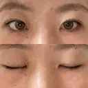 二重埋没 R.O.clinic AFTER サムネイル用