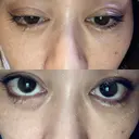 二重埋没 EMMO FACE CLINIC 大宮院 AFTER サムネイル用