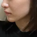 ヒアルロン酸注入（あご） / その他（輪郭） 東京形成美容外科 船橋院 AFTER サムネイル用