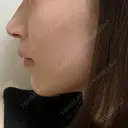 ヒアルロン酸注入（あご） / その他（輪郭） 東京形成美容外科 船橋院 DAY 613 サムネイル用